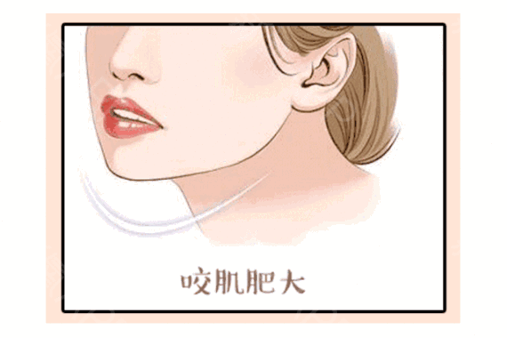 科普之什么是瘦脸针,打瘦脸针安全吗