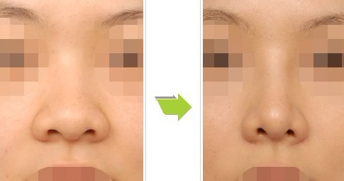 隆鼻手术是不是可以改善内眦赘皮 拉近眼距呢 钟爱梅副主任医师 爱问医生 隆鼻手术是不是可以改善内眦赘皮 拉近眼距呢 钟爱梅副主任医师 爱问医生