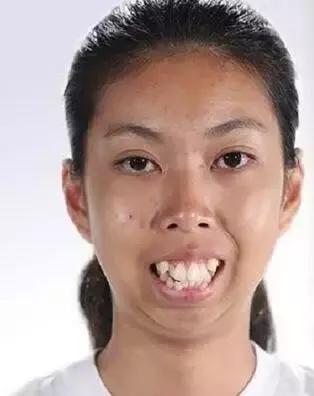 龅牙妹矫正一个月后大变身!从丑女变校园女神!
