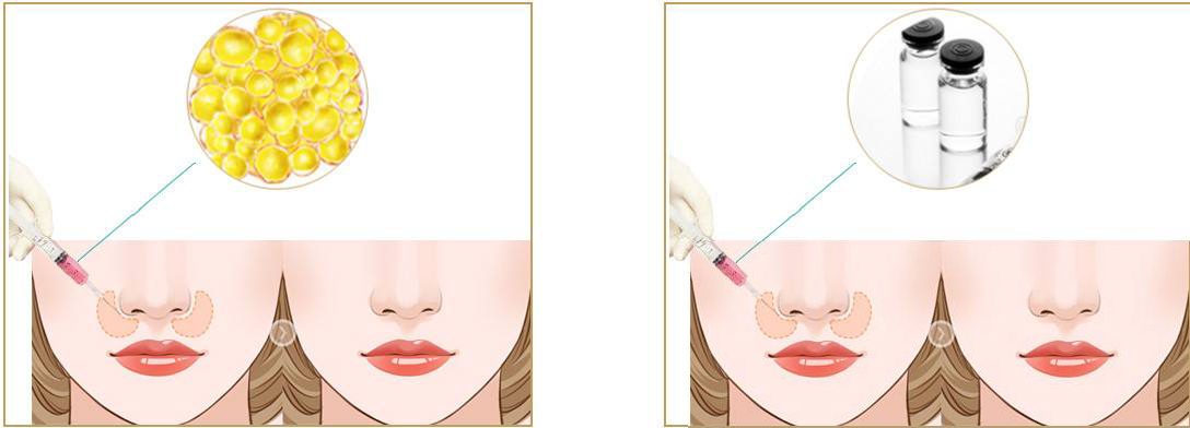 就想着"万能"的玻尿酸和脂肪,但鼻基底凹陷是骨性的问题,通过这种比较