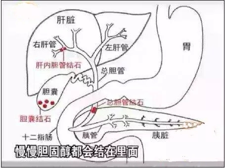 肝内胆管结石位置图图片