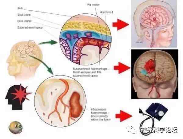 脑出血后神经细胞的死亡
