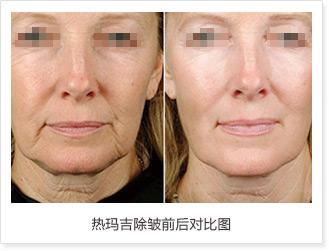 什么是热玛吉?效果怎么样?点进来告诉你!