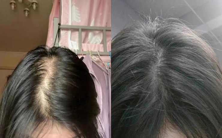 女人脱发怎么调理?爱美女性决不认命!