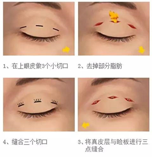 肿眼泡必看到底怎样才能让肿眼泡彻底消失