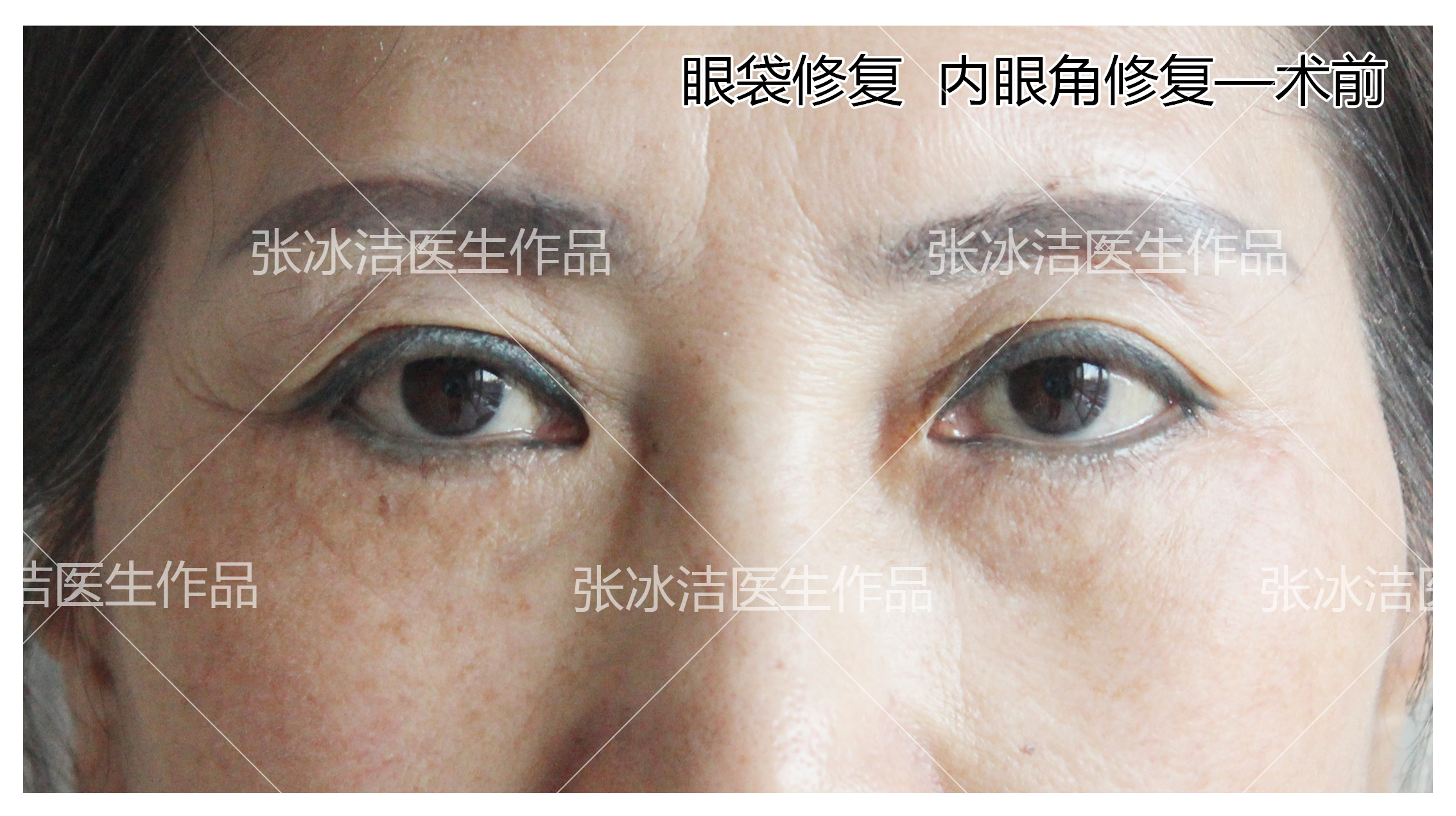 眼袋的形成原因及常见的处理方式-杜太超-爱问医生