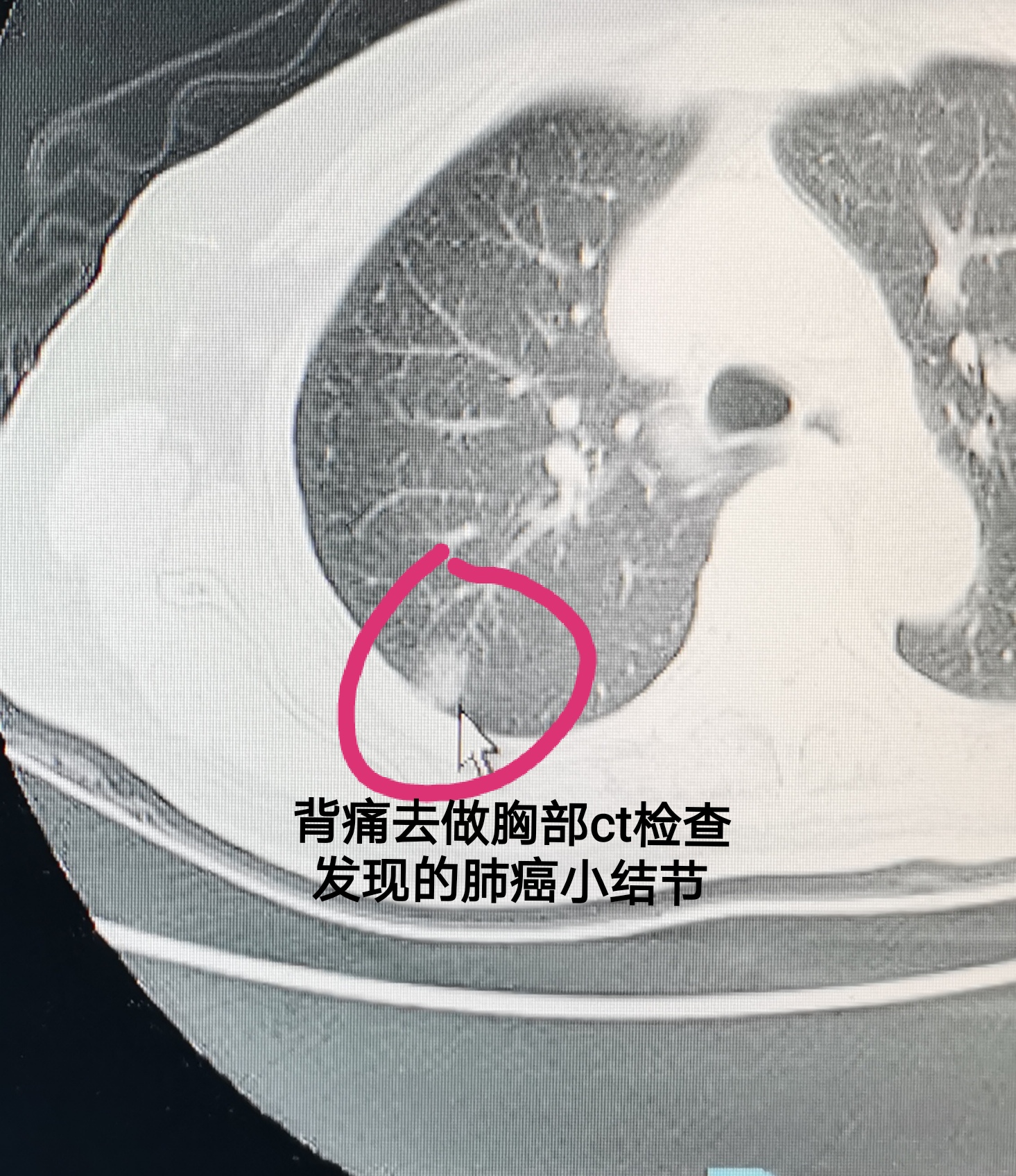 新冠肺炎的ct图片肺部图片