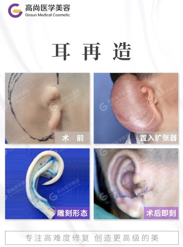 耳再造小甲腔型_耳再造小耳畸形_小耳再造