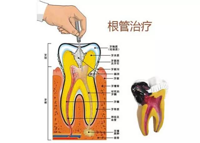 全口牙齿根管口分布图图片