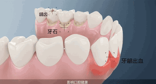 洗牙伤牙吗 会痛吗 史上最全洗牙知识都在这里 李思维 爱问医生