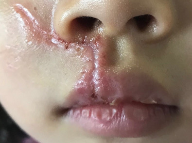 宝宝脸上的伤口一定要美容缝合!