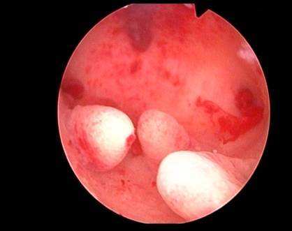 宫腔镜下正常宫腔图片图片