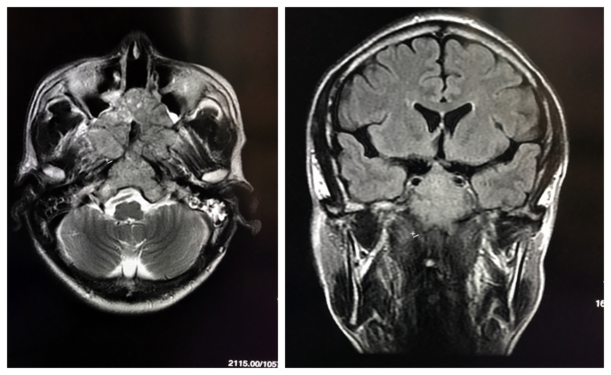 脊索瘤的治疗:颅内脊索瘤多发于中线颅底部位,手术完全切除困难.