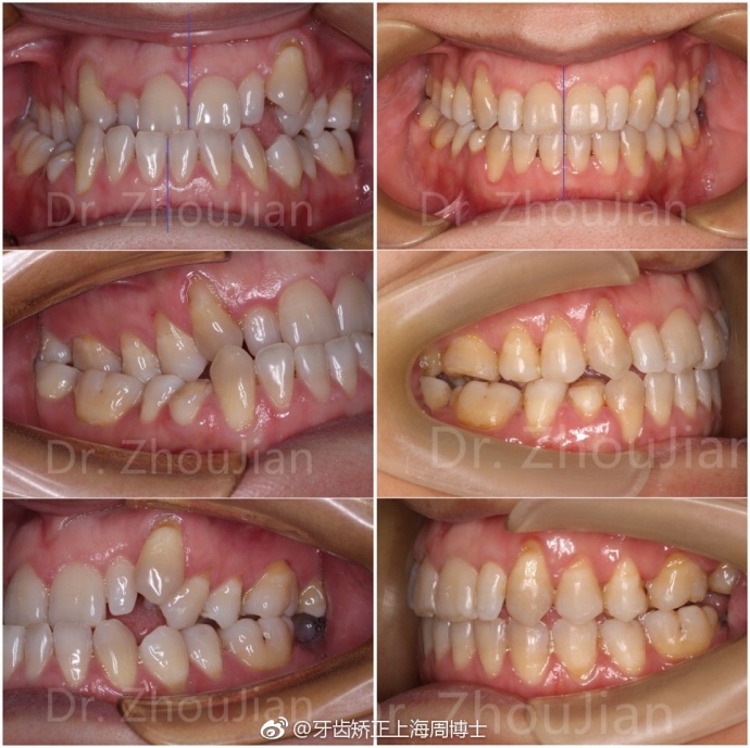 我这边不拔牙设计,掩饰治疗一年半完成,效果说明一切.