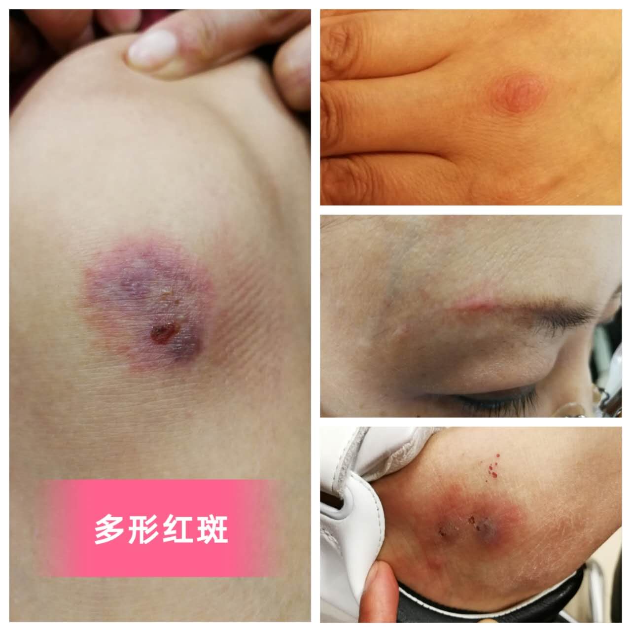 春季-多形红斑的好发季