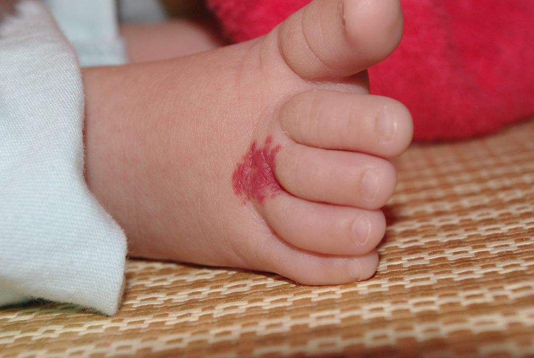 新生儿红斑图片血管瘤图片
