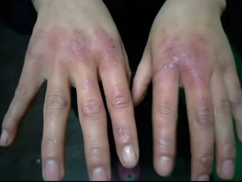 手脚冻僵千万不能这样处理!-钟晓红副主任医师-爱问医生