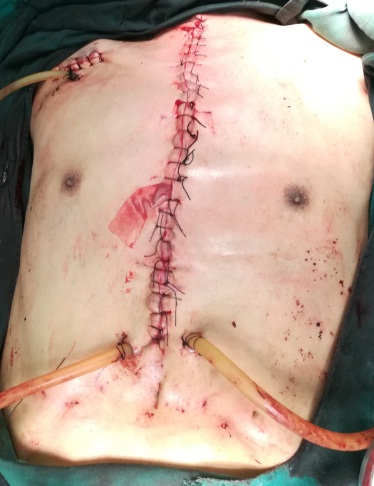 wang手术伟大实战成人重度胸廓畸形合并重度心脏病一期手术