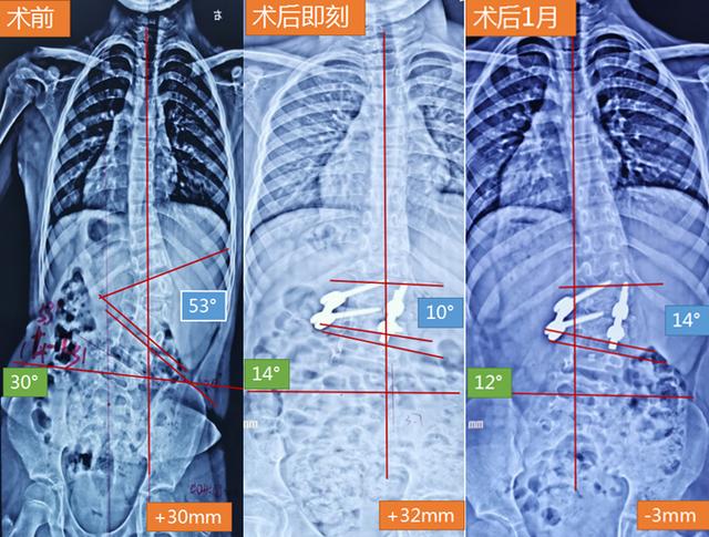 手術治療先天性脊柱側凸畸形脊髓縱裂病例分享