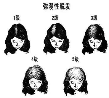 女性弥漫性脱发的原因及特点是什么