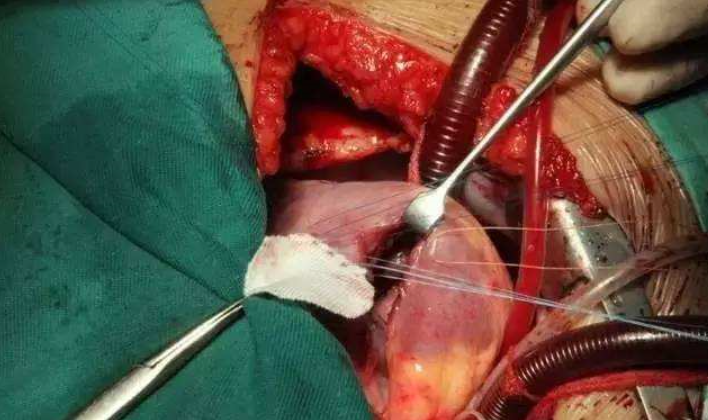在胸骨下段开一个小口子(长度只有开胸手术的1/3),将封堵器送入心脏