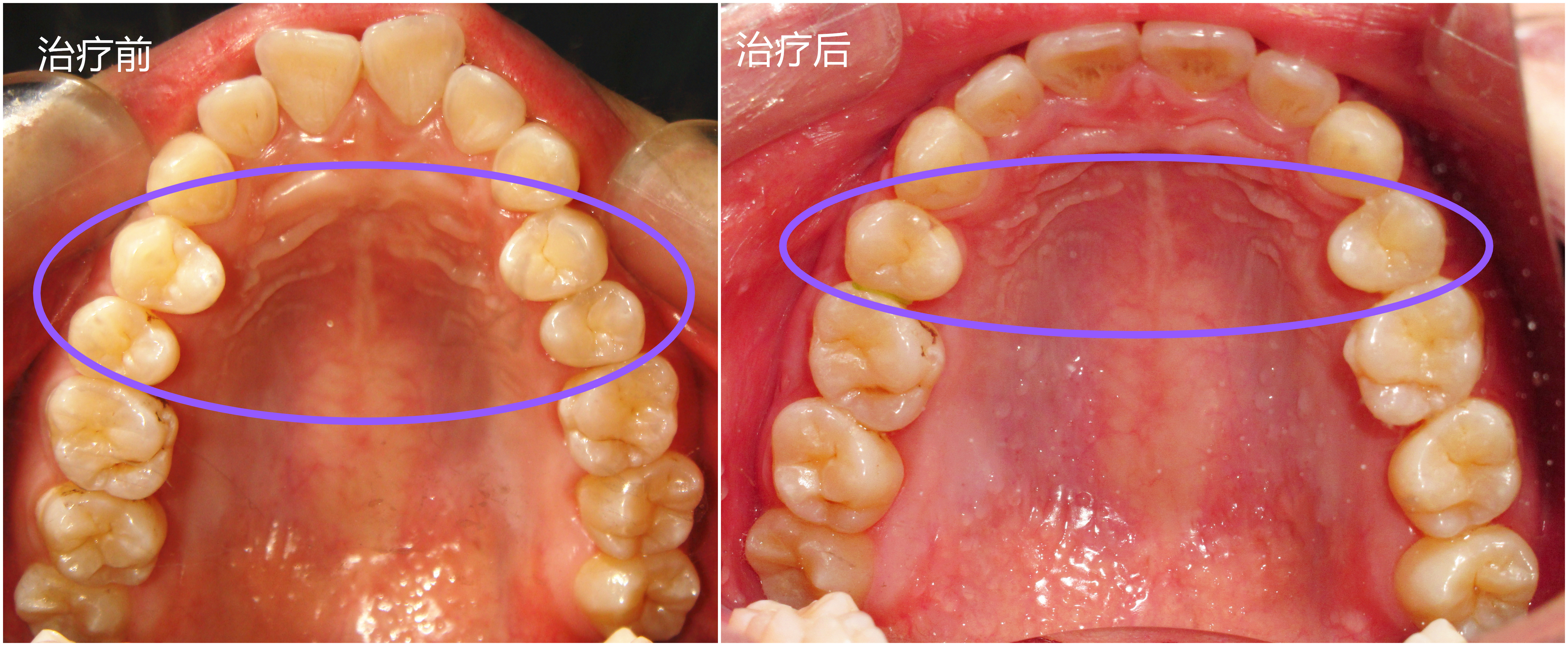 你不知道的牙齿矫正秘密深度剖析正畸拔牙和牙套脸