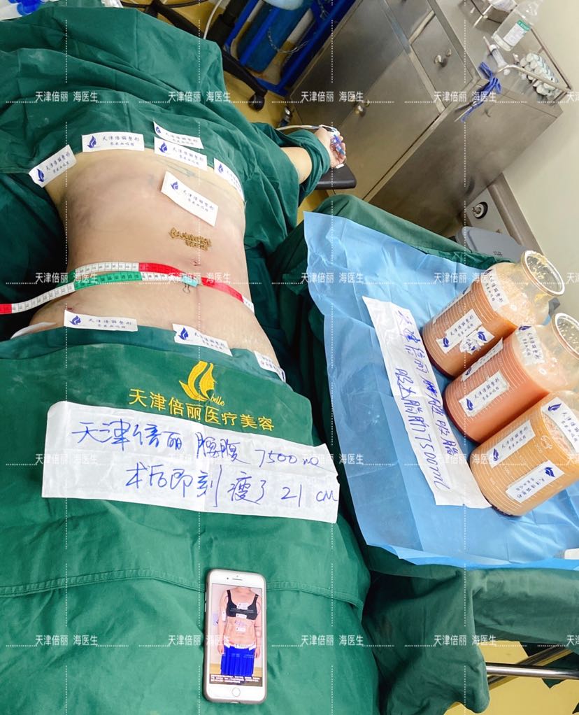 腹围减少21厘米,吸出纯脂肪7500毫升