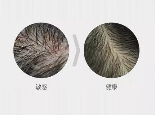 如何判断头皮是否健康,看看你达标了吗?