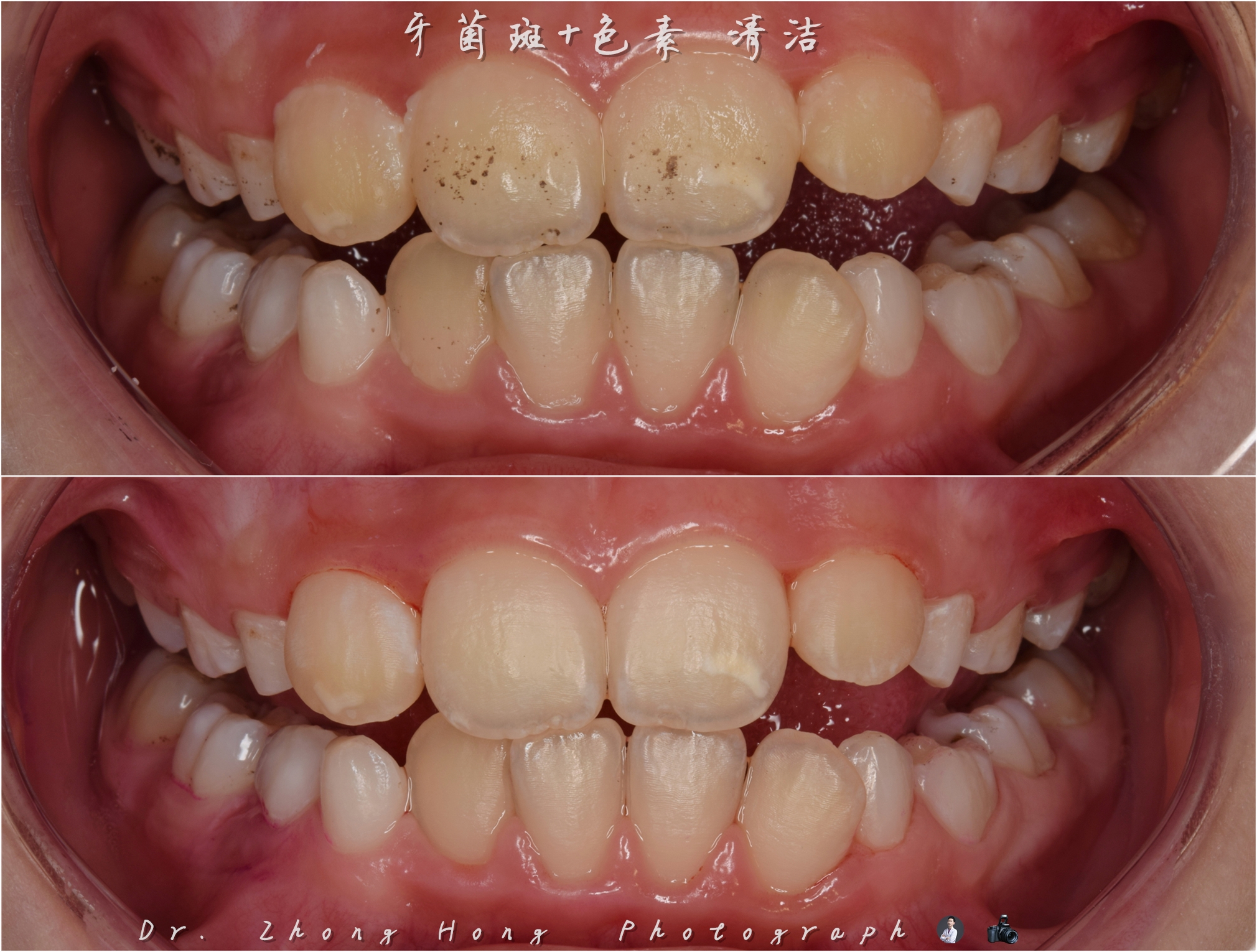牙齦黑色素沉澱 - 米羅牙醫診所
