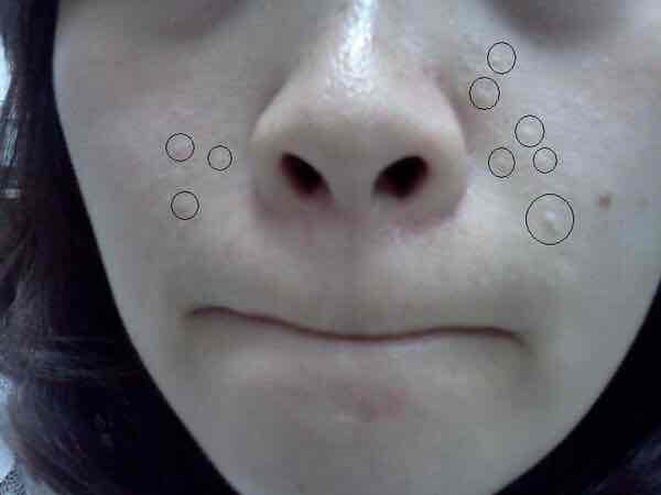 (闭口粉刺)白头粉刺怎么办