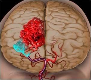什么是脑血管畸形?危险吗?怎么治疗?