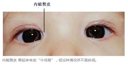 宝宝内斜视的症状图片图片