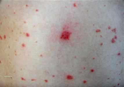 牛皮癣在临床上是如何分型