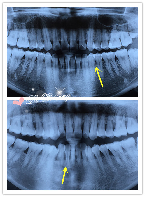 正常牙槽骨照片图片