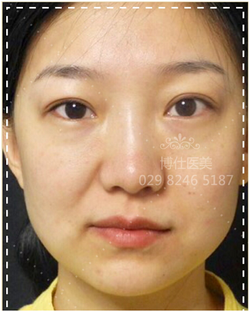 面部年轻化:线雕 乔雅登md code注射案例全面解析