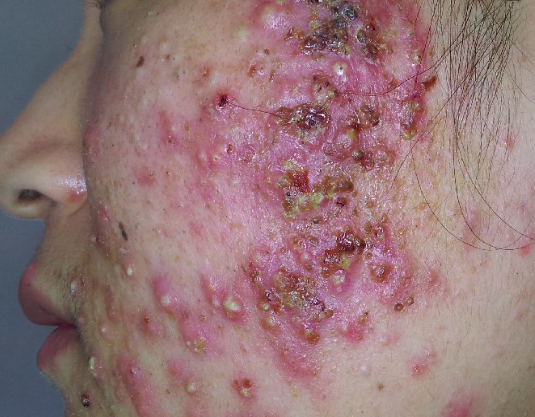 图解痤疮的类型