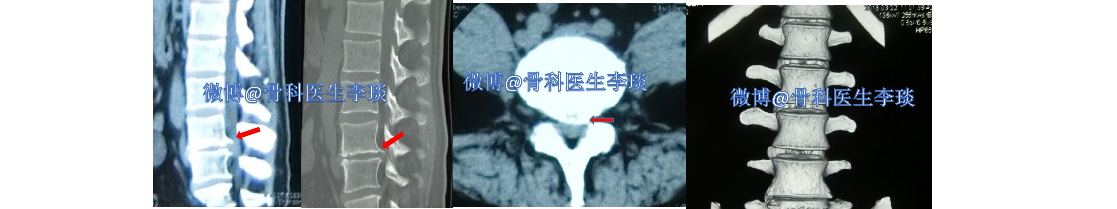 医生,磁共振都显示有间盘突出了,咋还要做ct?我说