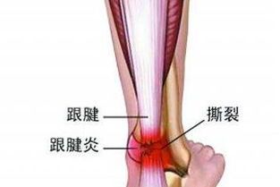 跟腱疼痛到跟腱斷裂之間的距離有多遠