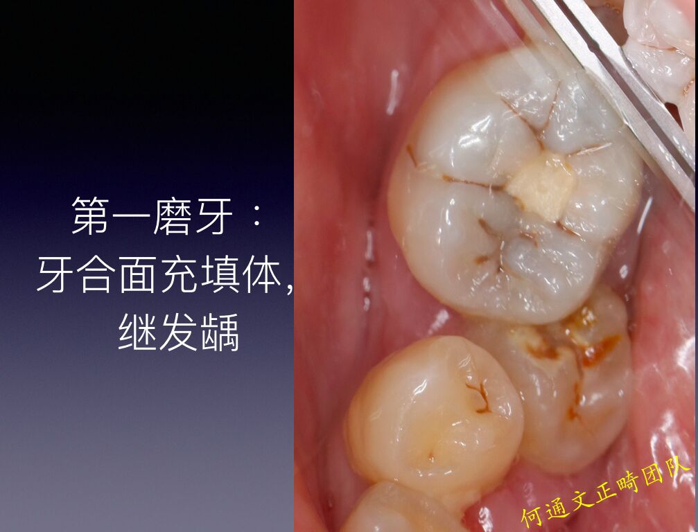 最容易被忽视,确危害十足的------龋齿