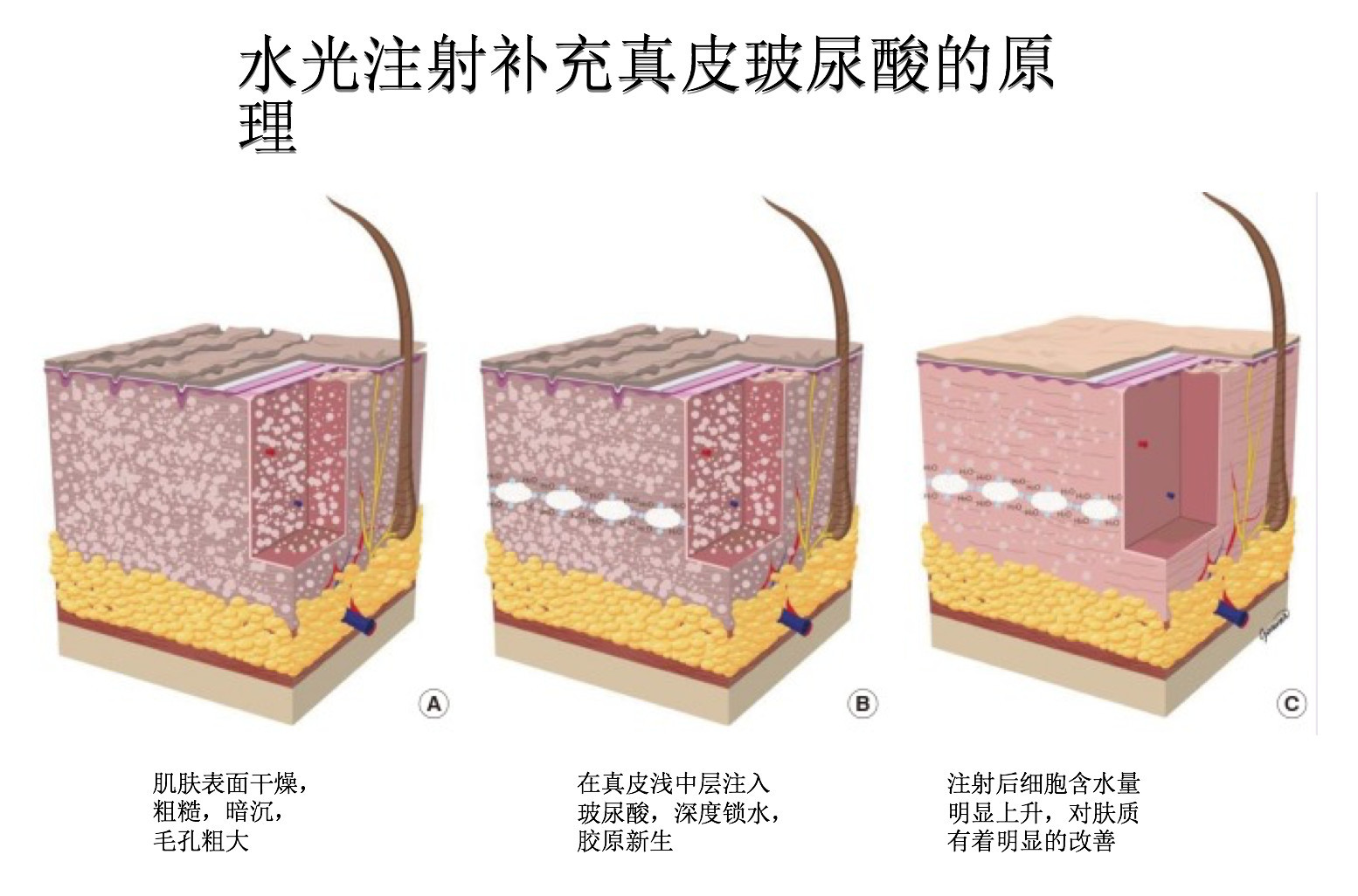 客官 神秘的中胚層抗衰療法 不是你熟知的水光針!