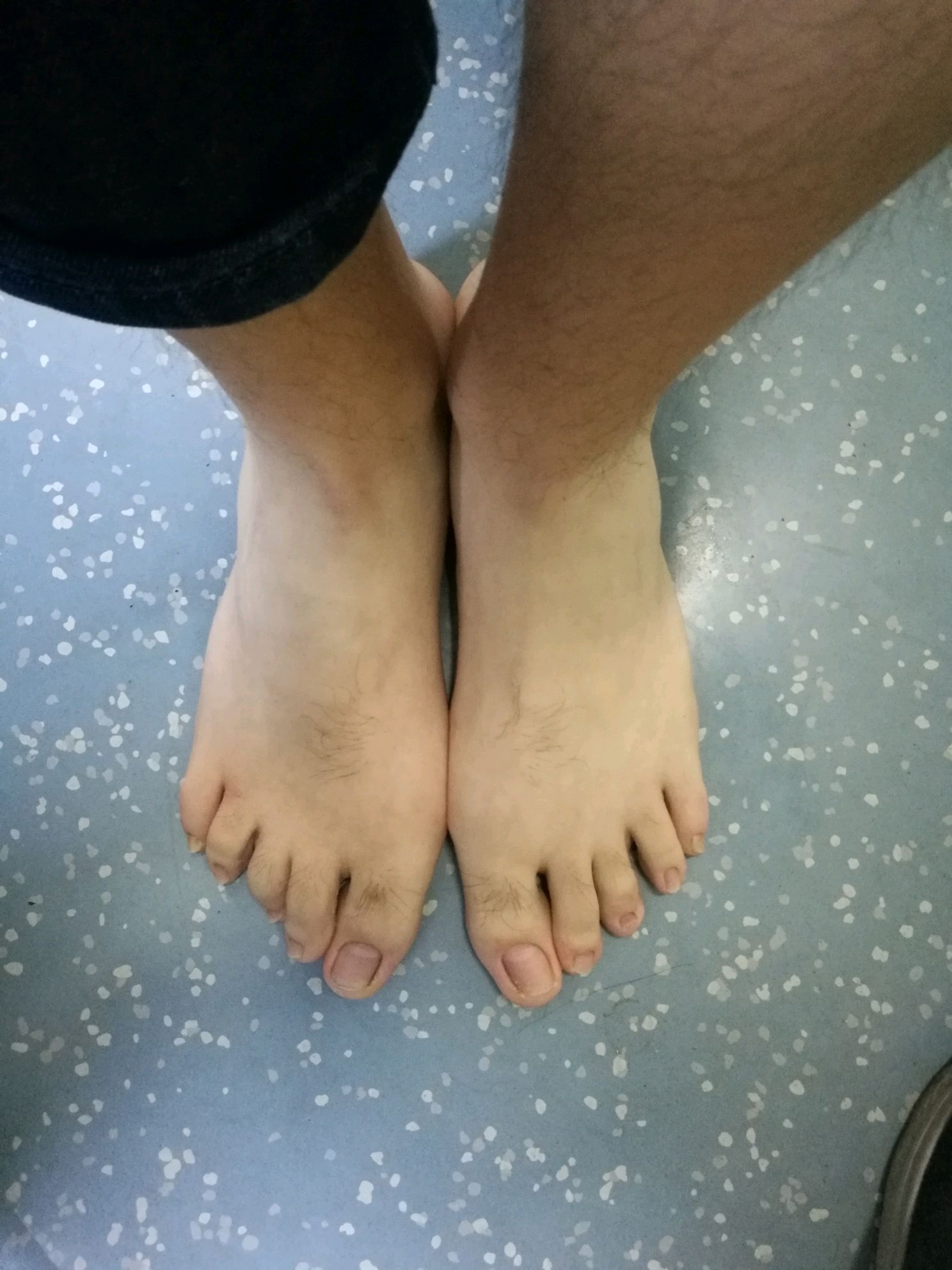 青年男性拇外翻畸形