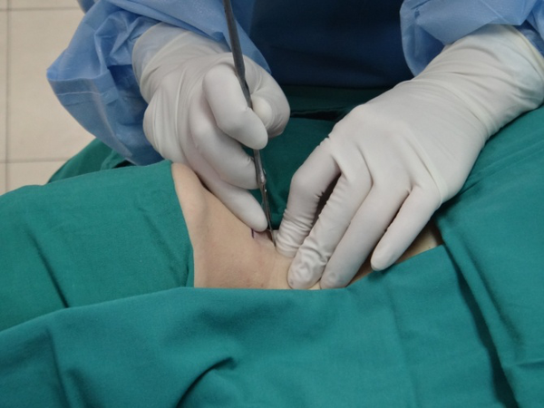 怎么才能灭了巧克力囊肿?