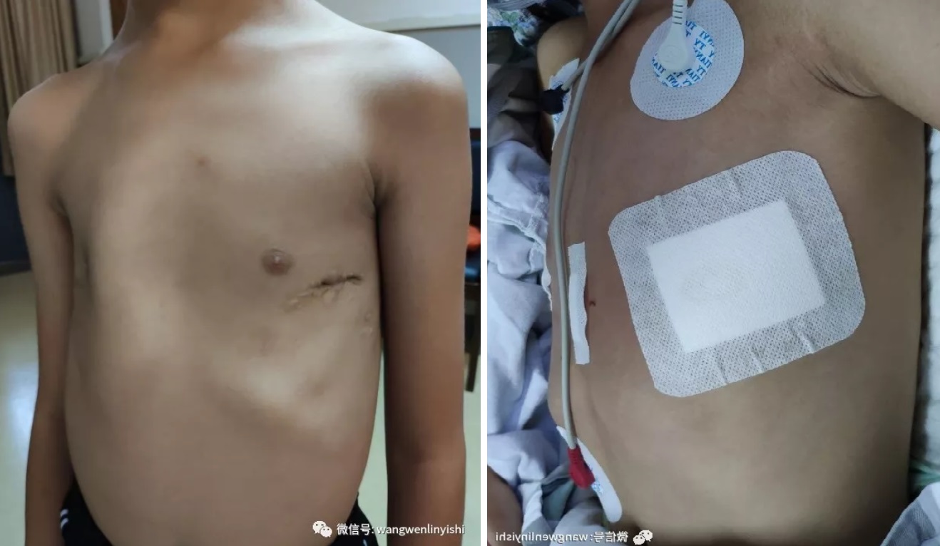 专治各种漏斗胸手术失败:改良wang手术-王文林主任医师-爱问医生