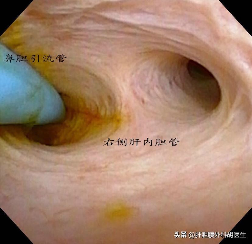 胆道镜检查_胡志秋_副主任医师_爱问健康