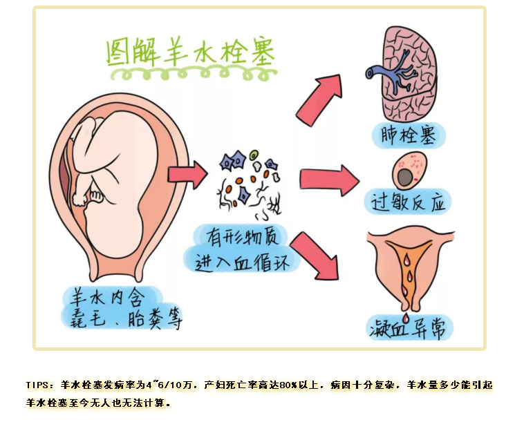 羊水栓塞图片 漫画图片