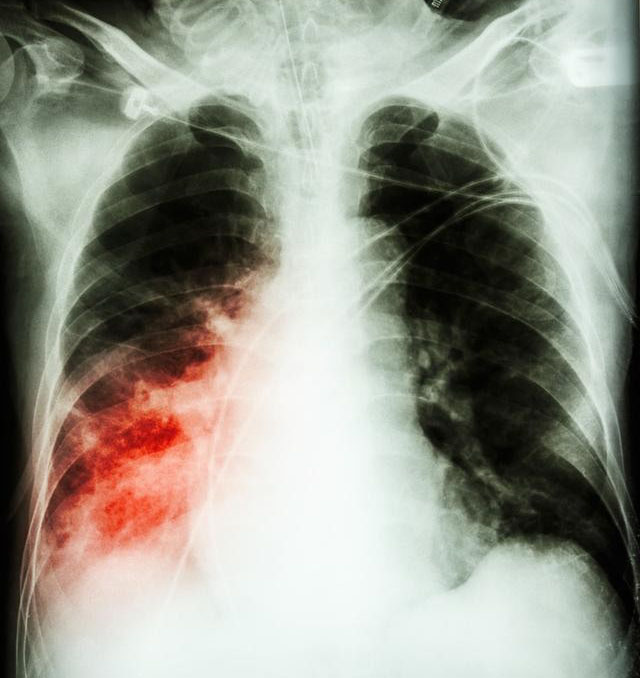 肺腺癌图片全景图图片