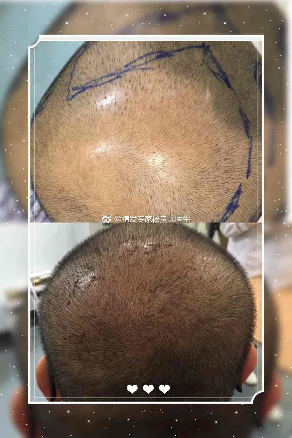 毛囊的合理分布