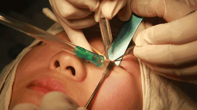 对于年轻人群,爱美人群,商务人士等 小佳强烈建议选择激光无痕祛眼袋