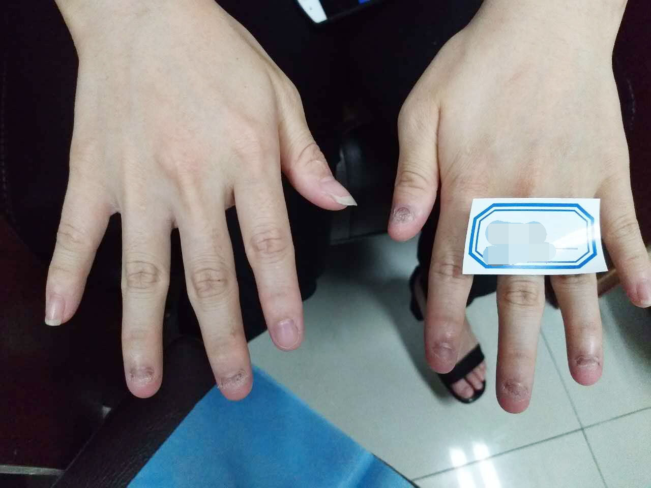 甲萎缩康复过程