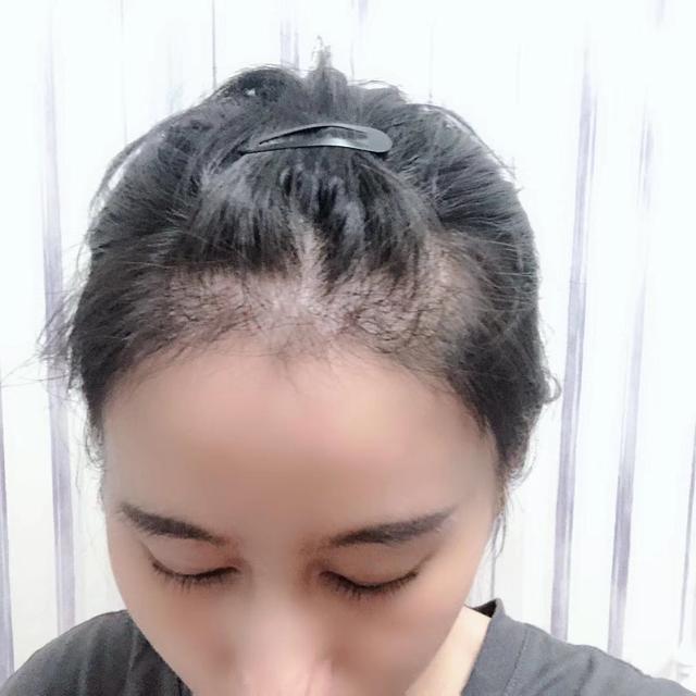 术后六个月,程女士种植的头发已经完全长出, 前额已经没有任何裸露